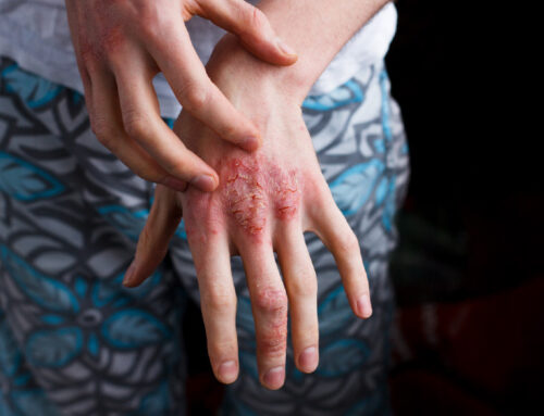 Comprehensive Health Strategies to Manage Psoriasis: An Integrative Approach